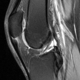 Ressonância magnética de joelho, evidenciando uma inflamação na região proximal do tendão patelar 