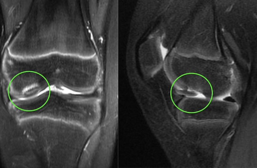 Figura ilustrativa de uma imagem de ressonância magnética do joelho mostrando lesão condral destacada 