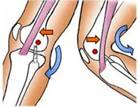 Figura ilustrativa mostrando o atrito do trato iliotibial ao epicôndilo lateral do fêmur 