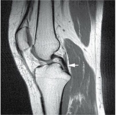 lesao ligamento cruzado posterior