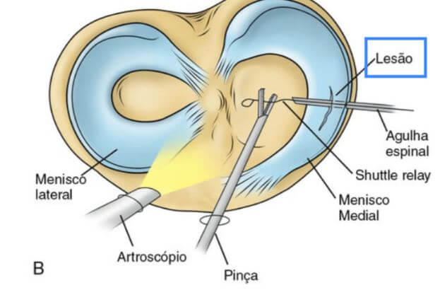 Lesão do Menisco