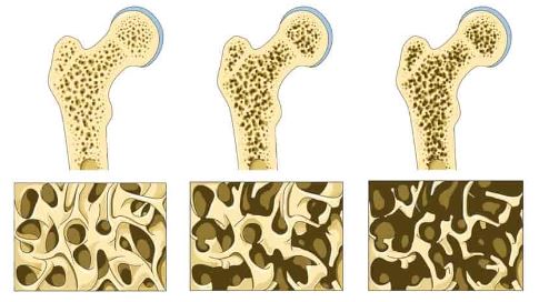 Osteoporose e Osteopenia