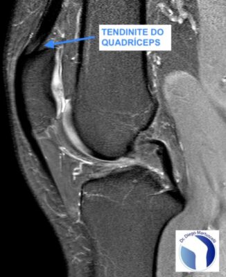 Tendinite dos Quadríceps